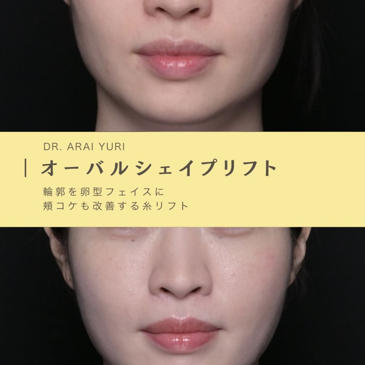 糸リフトのビフォーアフター写真