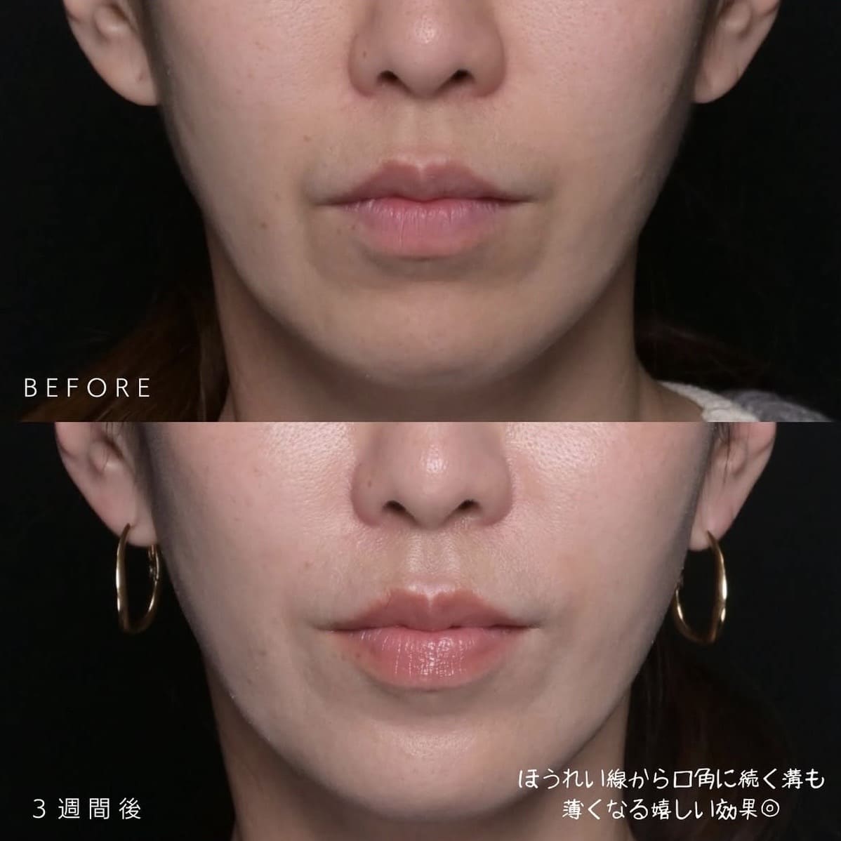 ジュブゼンのビフォーアフター写真