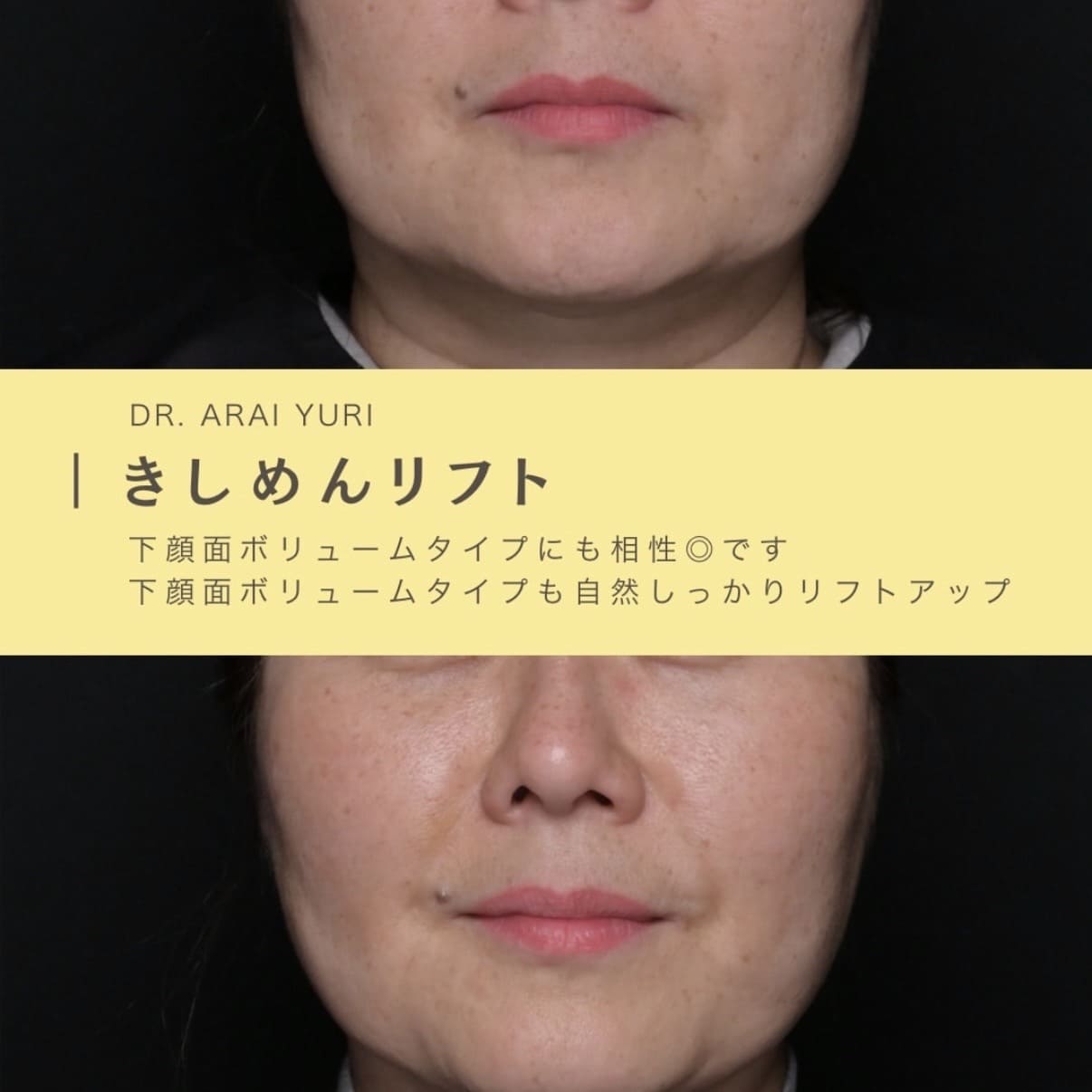糸リフトのビフォーアフター写真