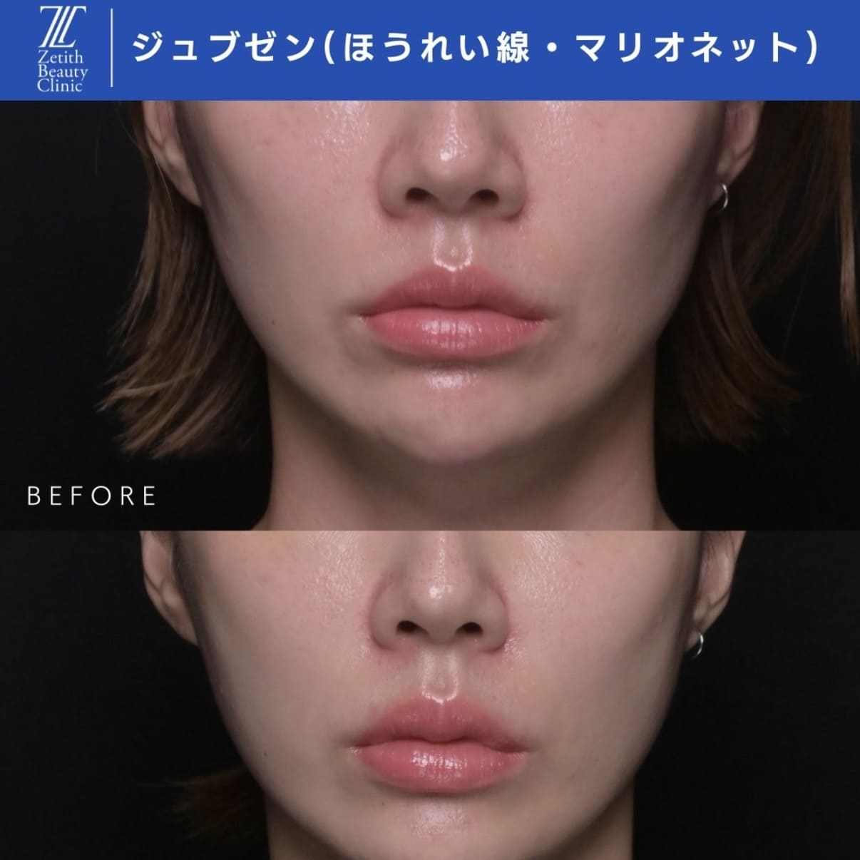 ジュブゼンのビフォーアフター写真