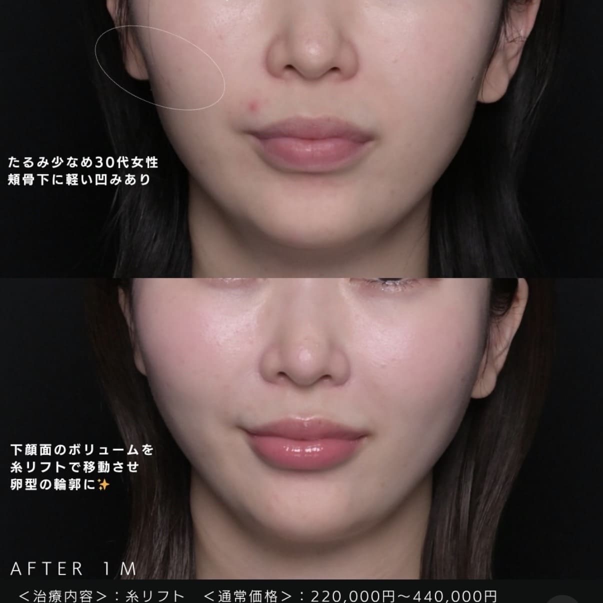 糸リフトのビフォーアフター写真