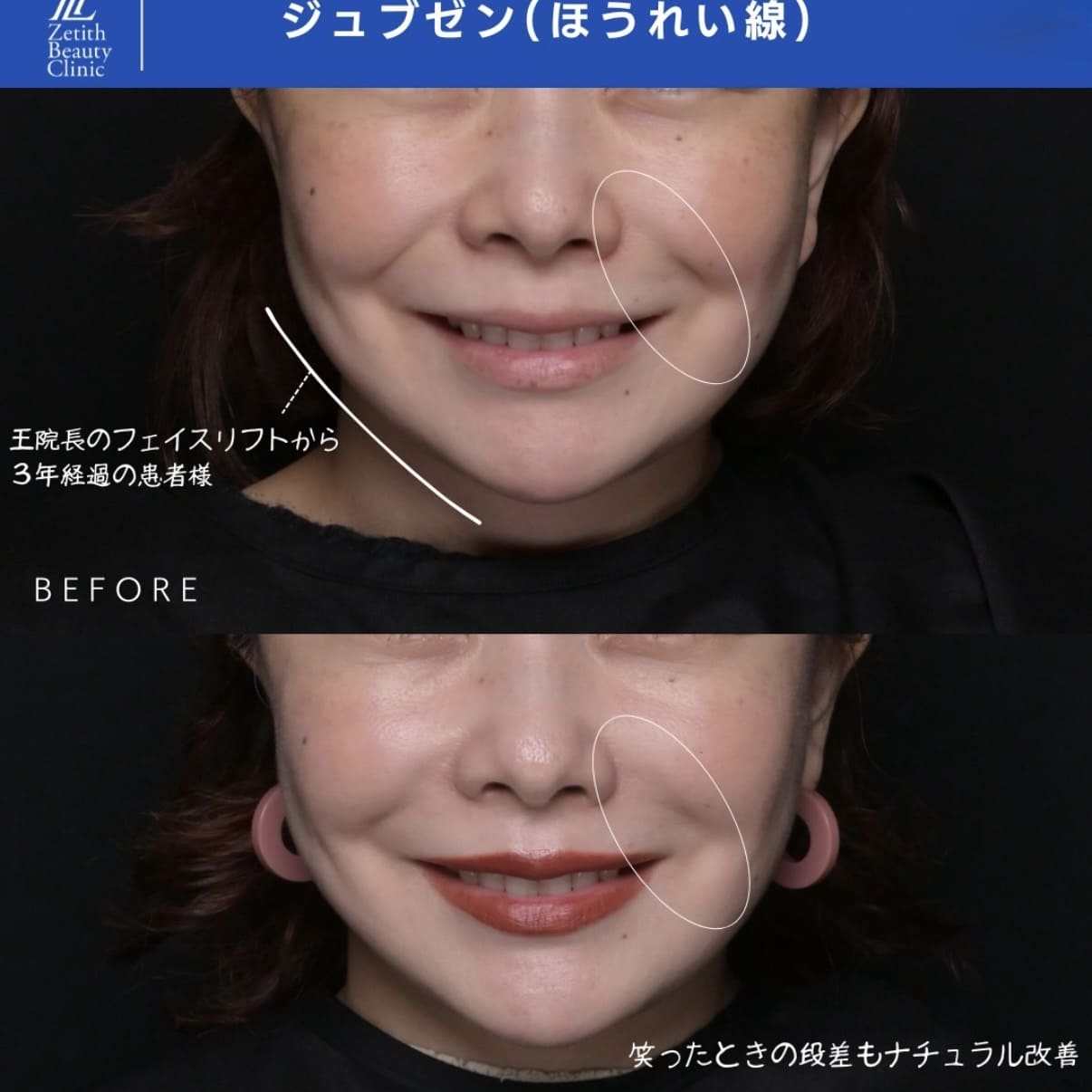 ジュブゼンのビフォーアフター写真