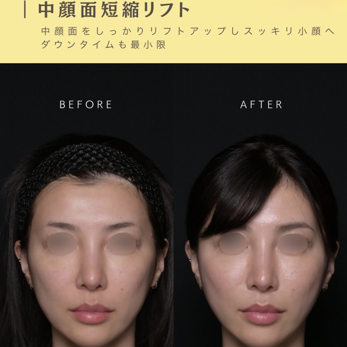 糸リフトのビフォーアフター写真