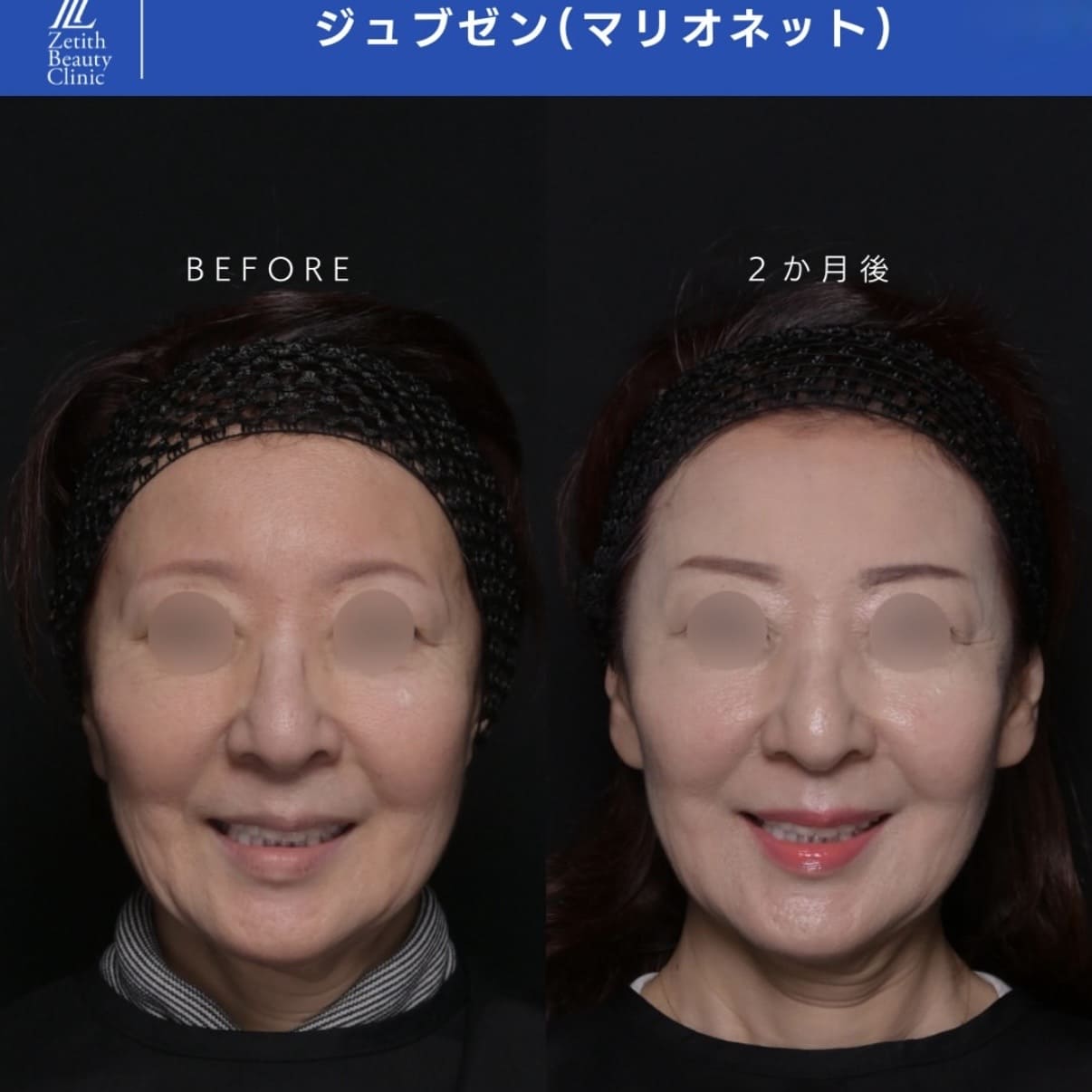 ジュブゼンのビフォーアフター写真