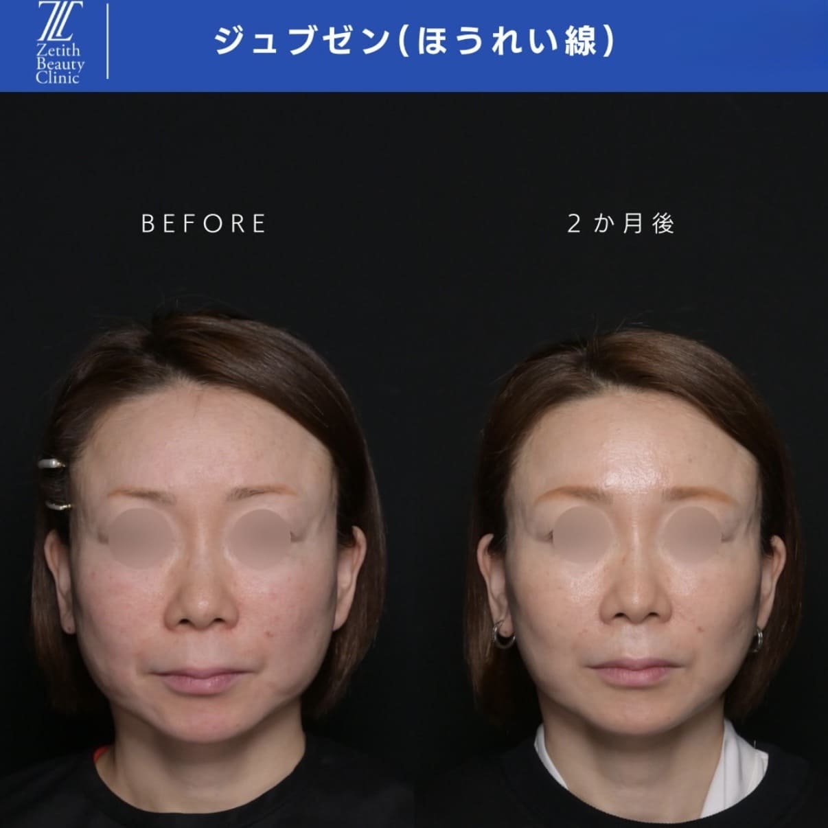 ジュブゼンのビフォーアフター写真