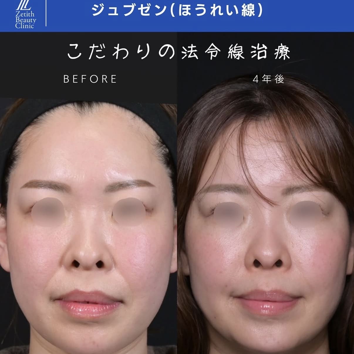 ジュブゼン・糸リフト・ヒアルロン酸注入・ボトックス注入・脂肪溶解注射のビフォーアフター写真