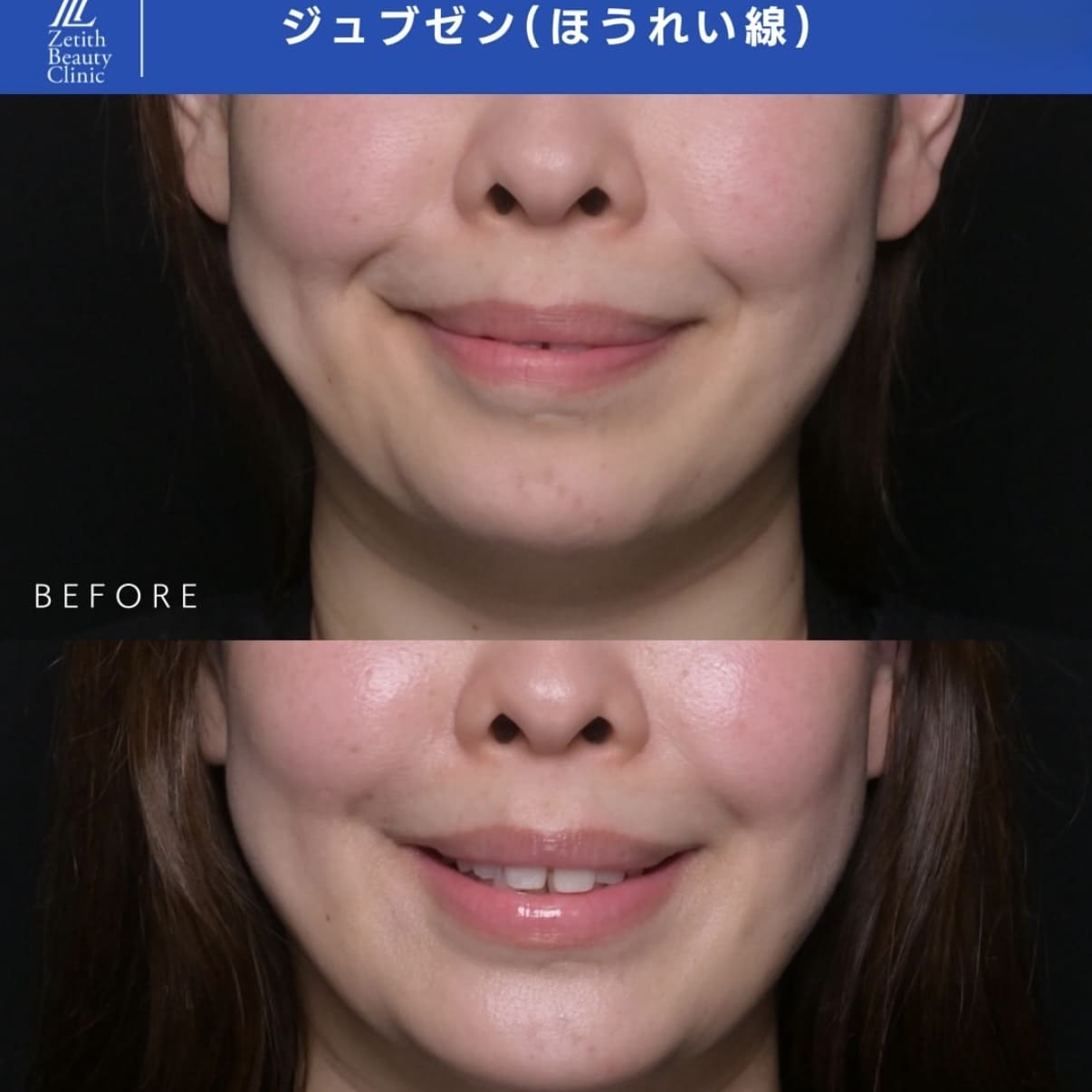 ジュブゼンのビフォーアフター写真