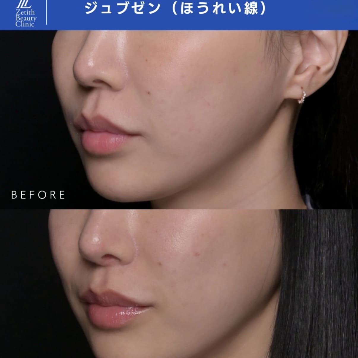 ジュブゼンのビフォーアフター写真