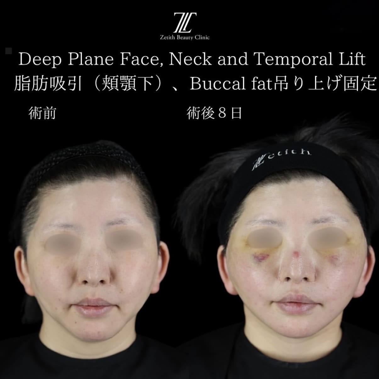 フェイスリフトのビフォーアフター写真