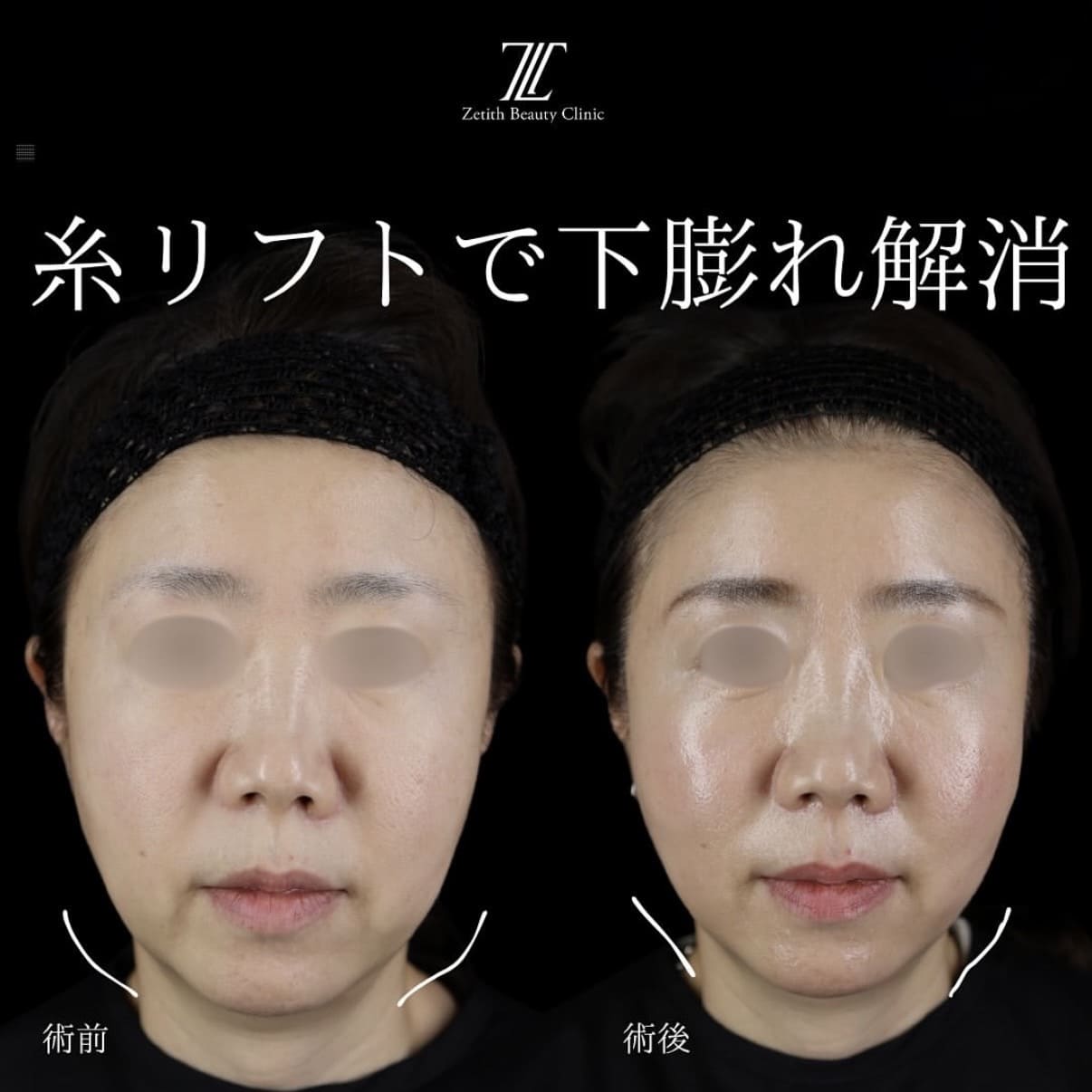 糸リフトのビフォーアフター写真