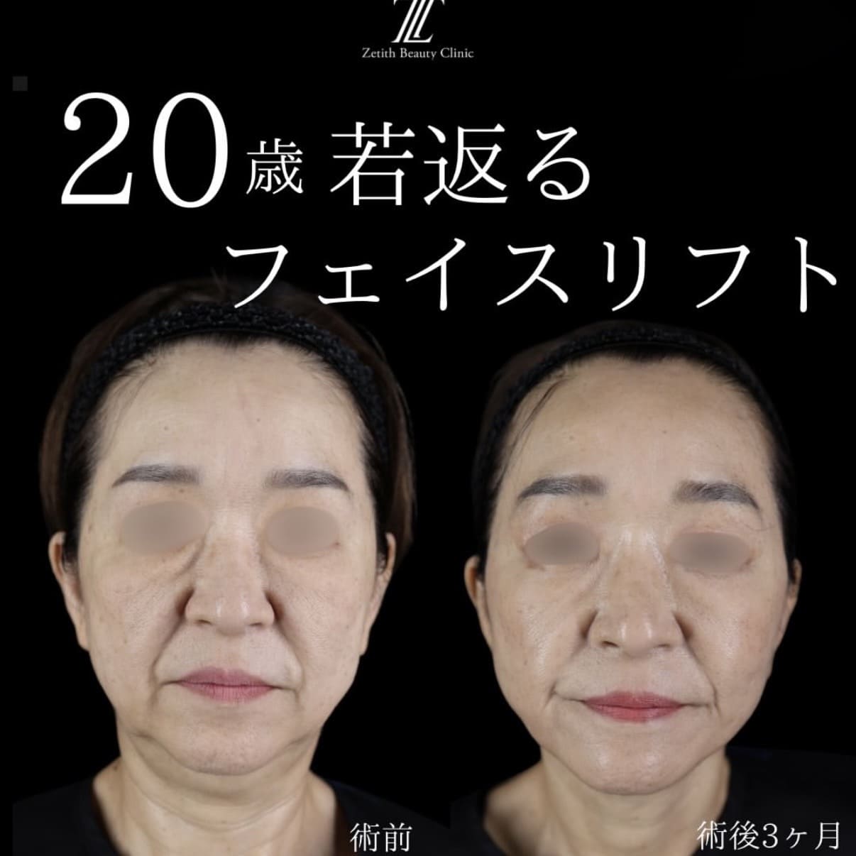 フェイスリフトのビフォーアフター写真