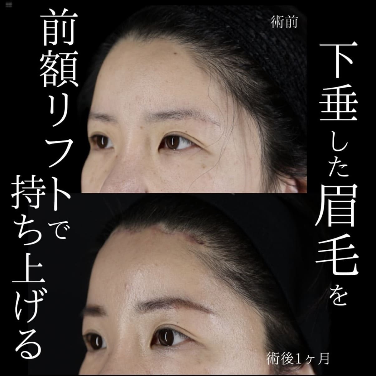 フェイスリフトのビフォーアフター写真