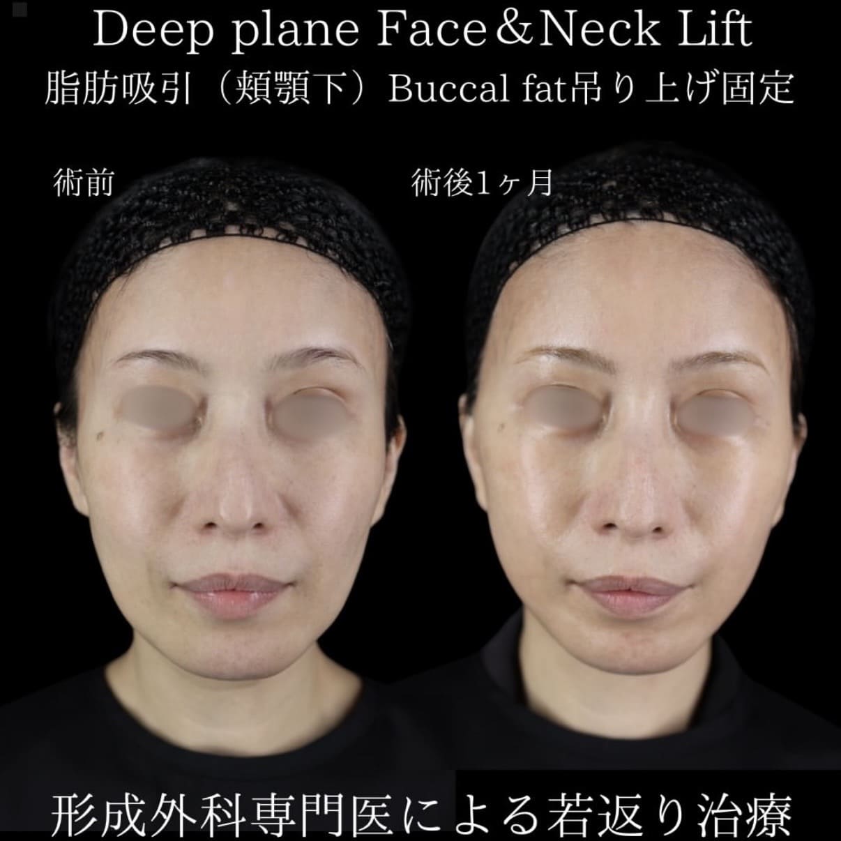 フェイスリフトのビフォーアフター
