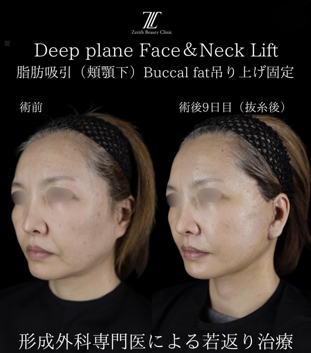 フェイスリフトのビフォーアフター写真