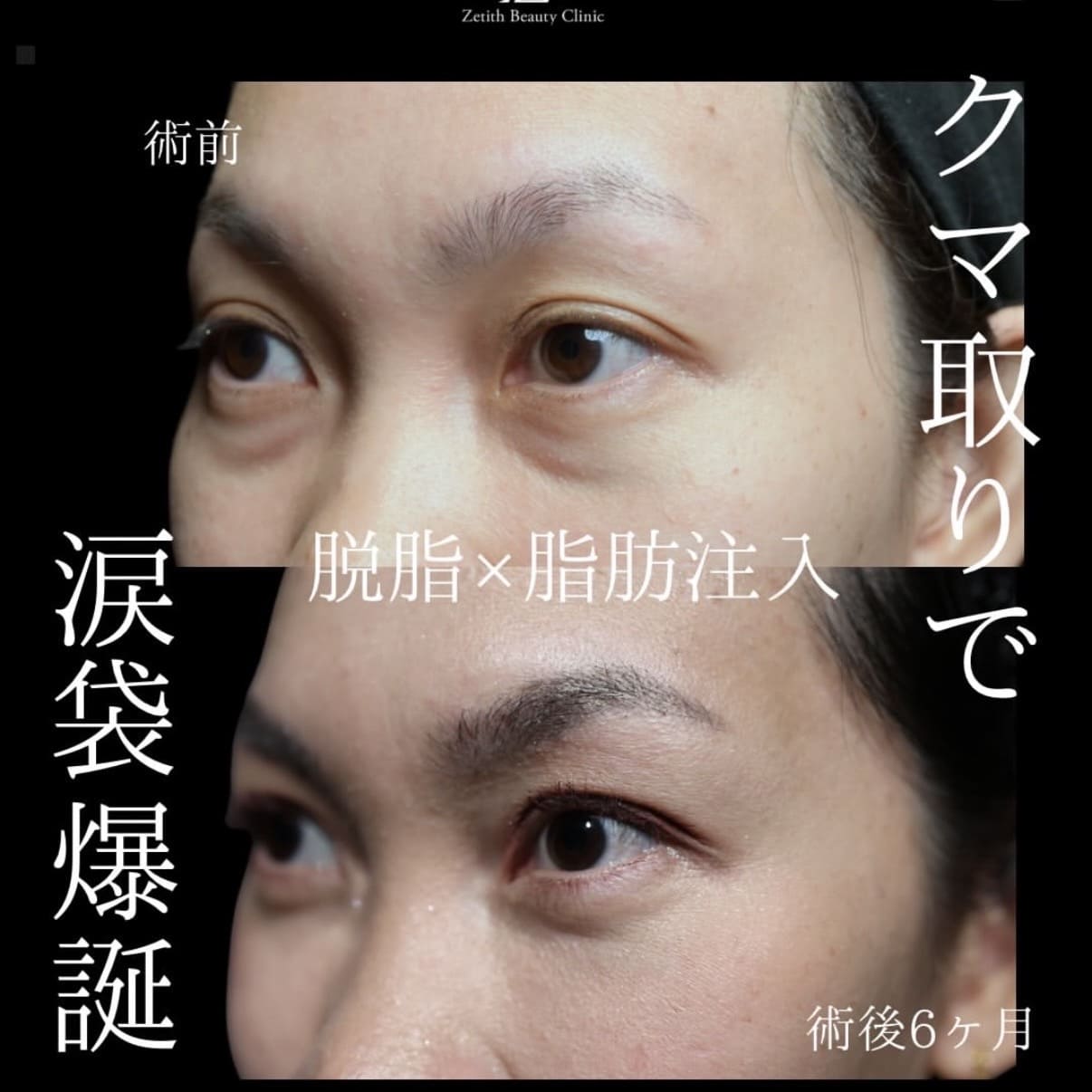 クマ取りのビフォーアフター写真