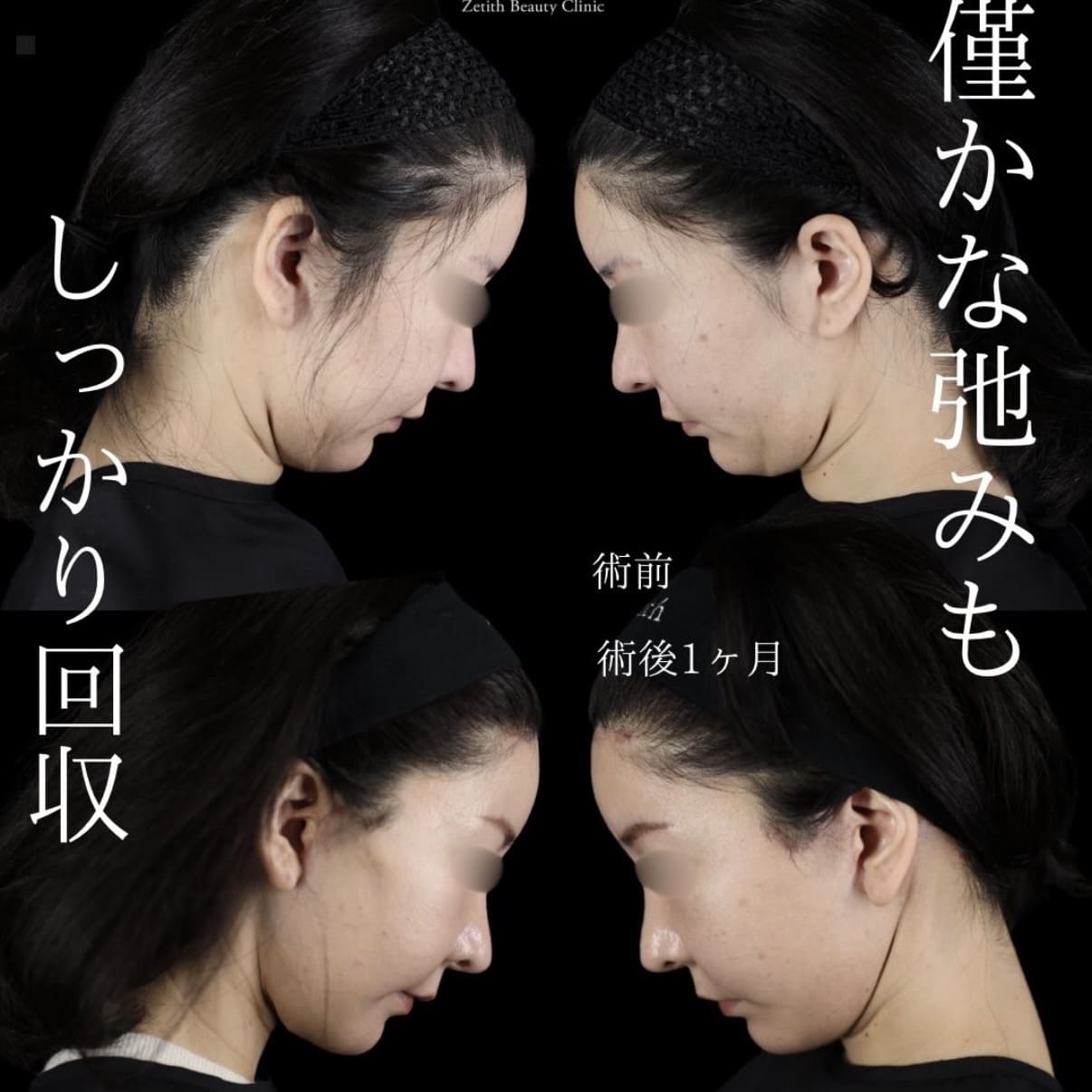 フェイスリフトのビフォーアフター