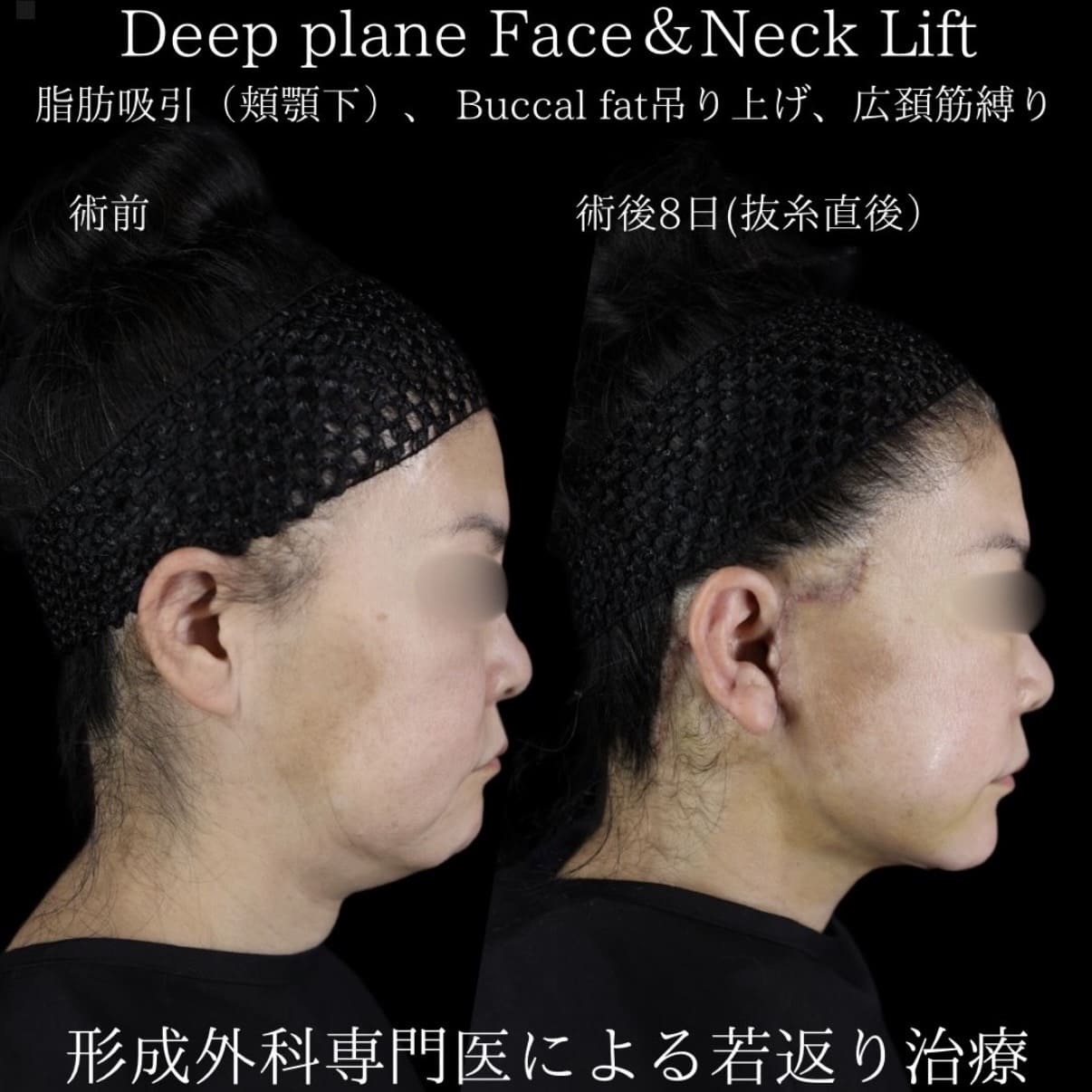 フェイスリフトのビフォーアフター