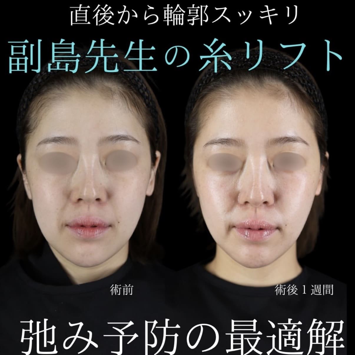 糸リフトのビフォーアフター写真