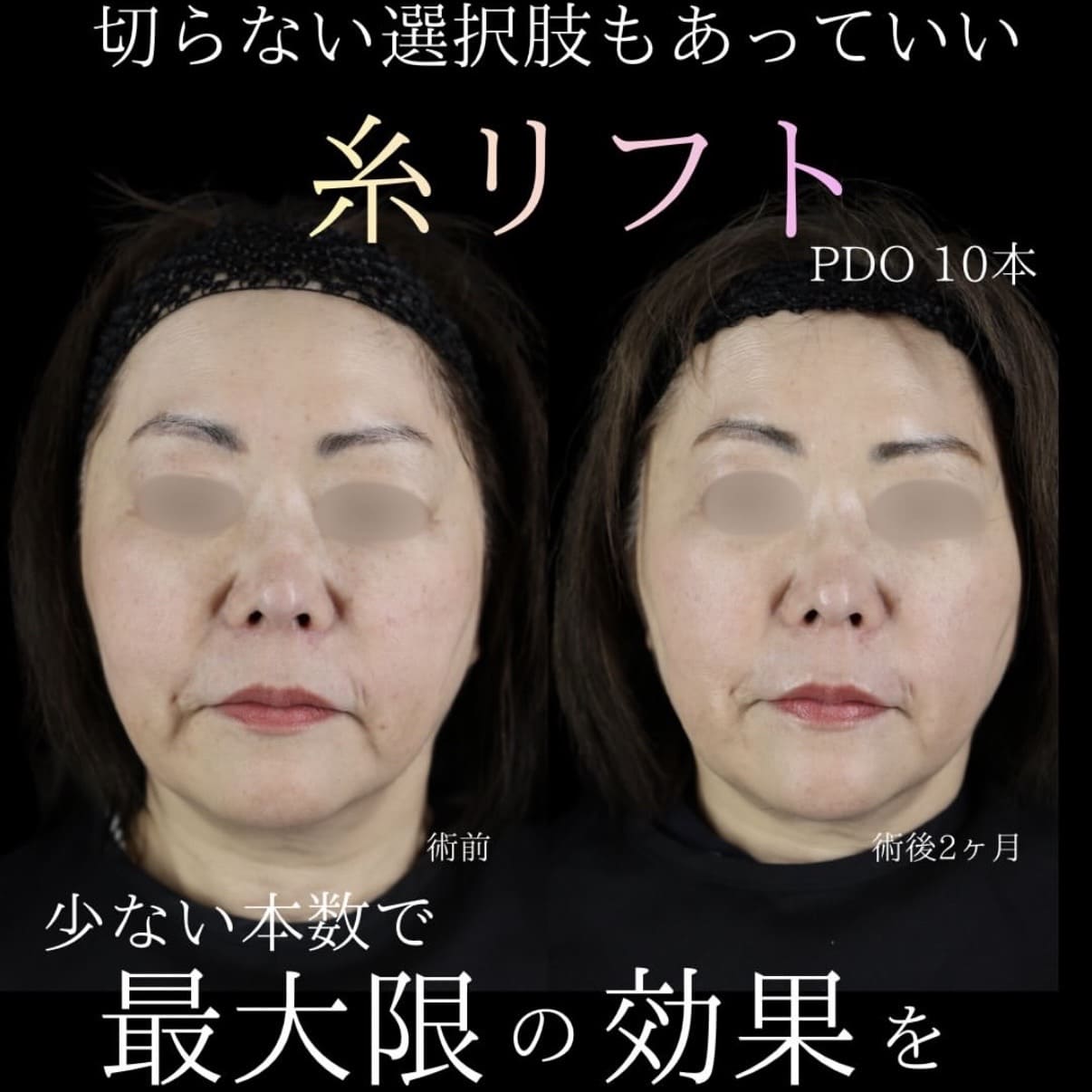 糸リフトのビフォーアフター写真