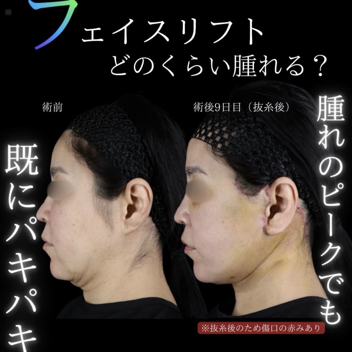 フェイスリフトのビフォーアフター写真