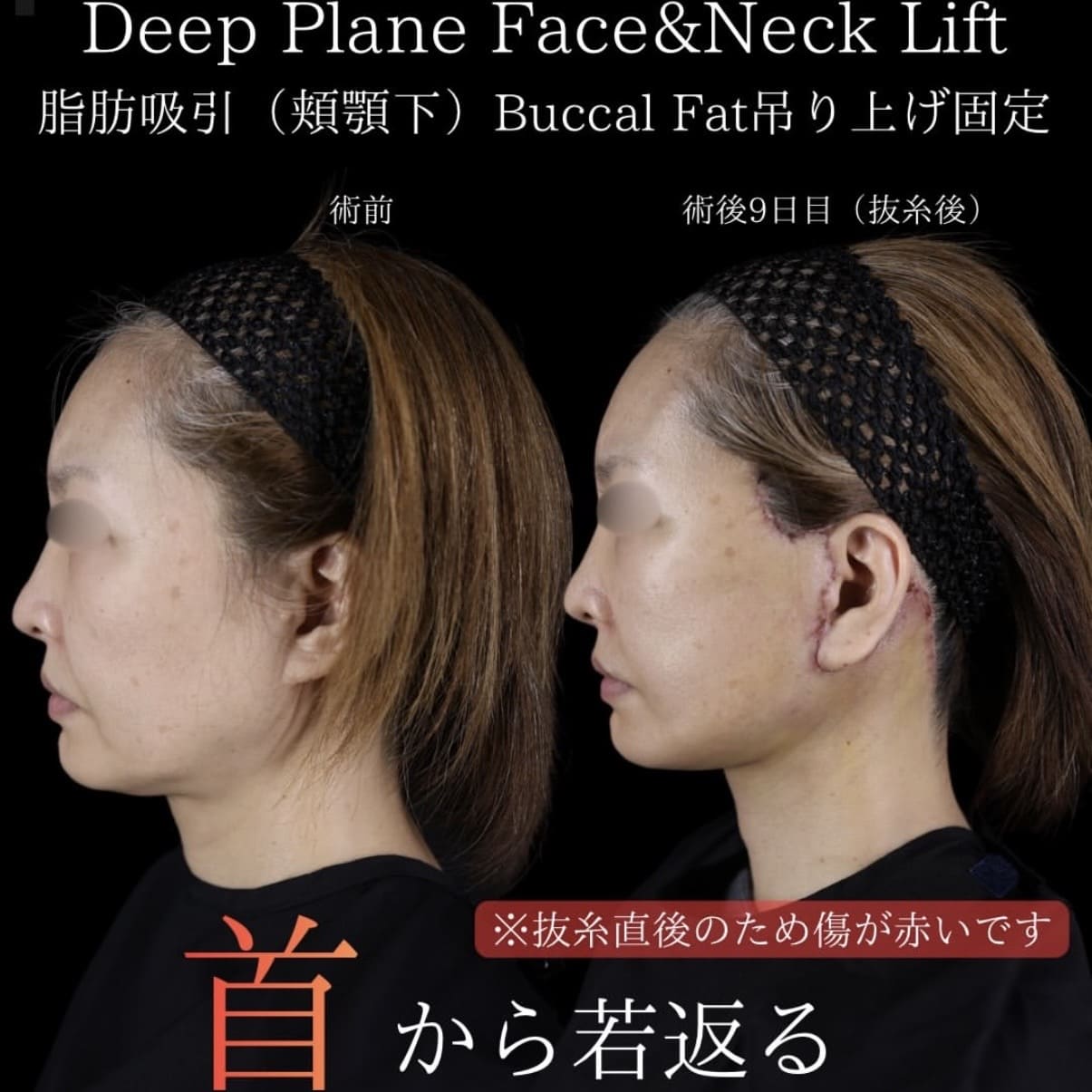 フェイスリフトのビフォーアフター写真