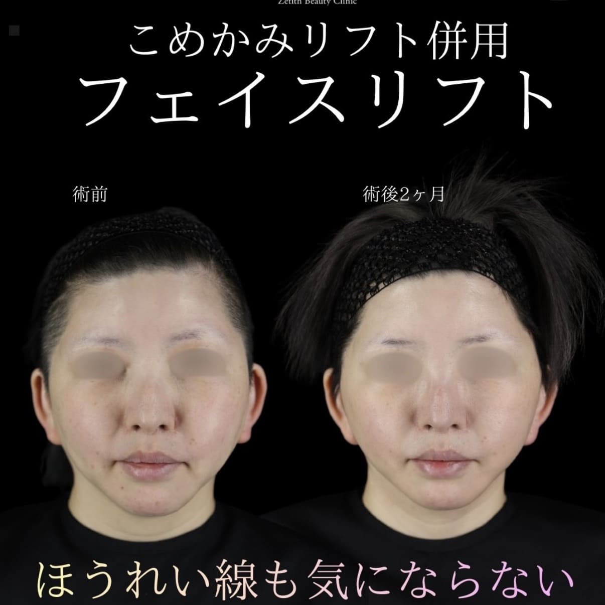 フェイスリフトのビフォーアフター写真
