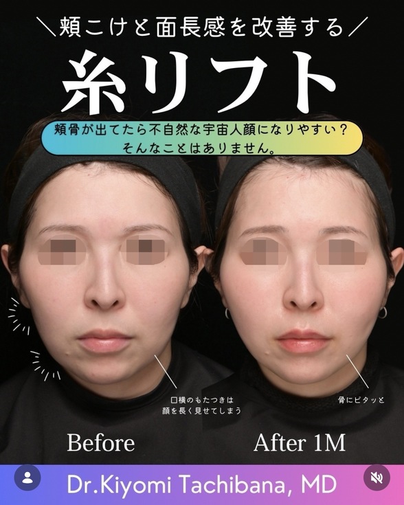 糸リフトのビフォーアフターの写真
