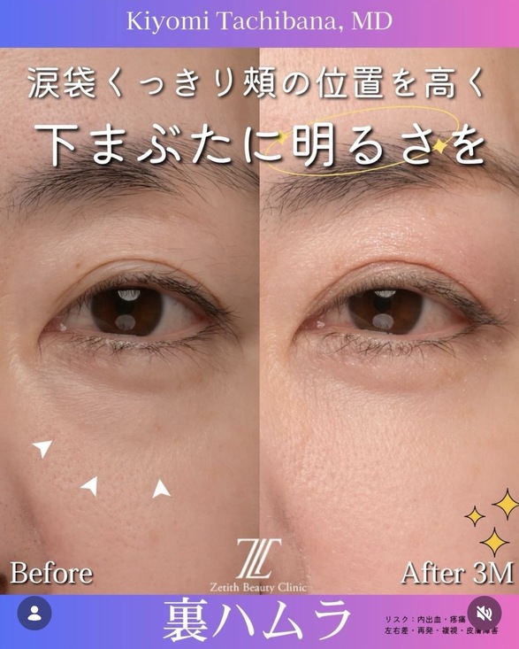 裏ハムラ法のビフォーアフターの写真
