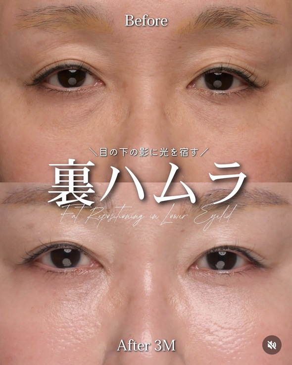 裏ハムラ法のビフォーアフターの写真