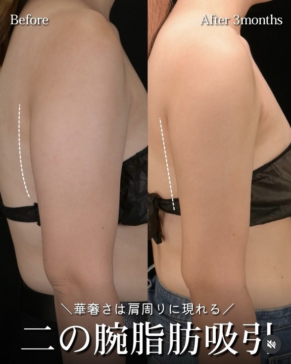 脂肪吸引のビフォーアフターの写真