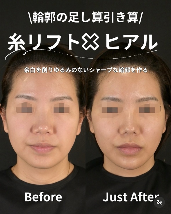 複合施術のビフォーアフターの写真