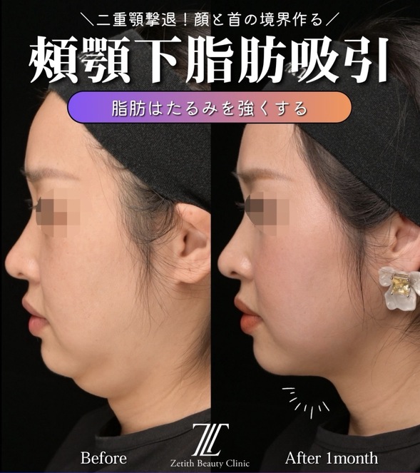 脂肪吸引のビフォーアフターの写真
