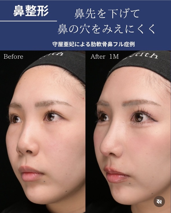 鼻整形のビフォーアフター写真