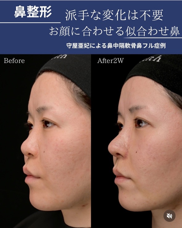 鼻整形のビフォーアフター写真