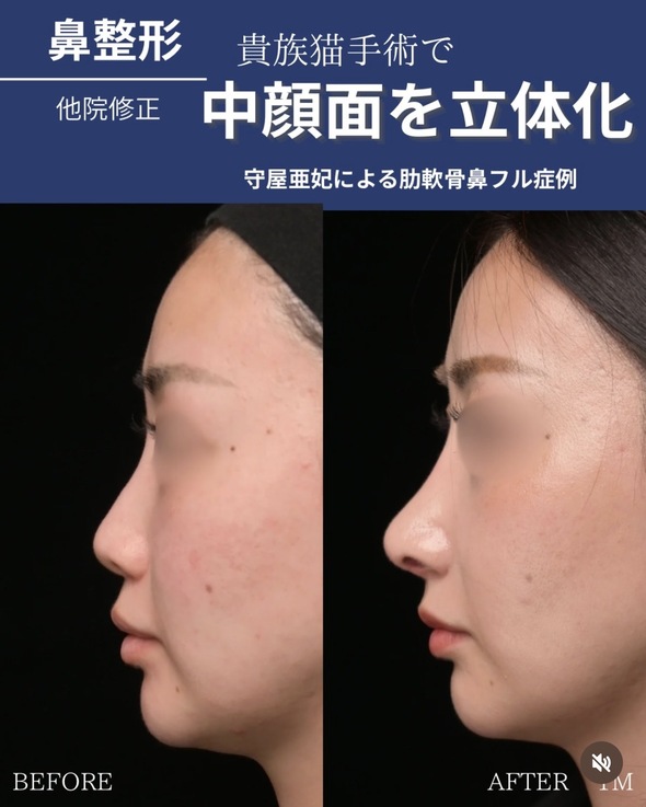 鼻整形のビフォーアフター写真