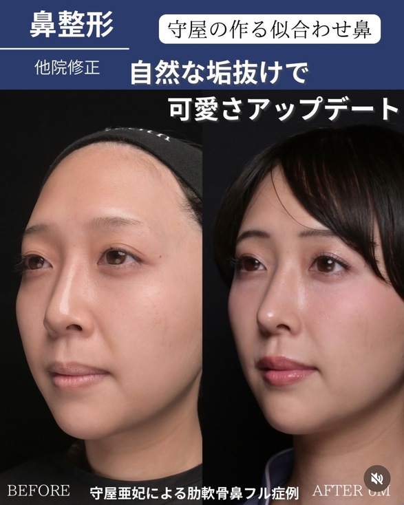 鼻整形のビフォーアフター写真