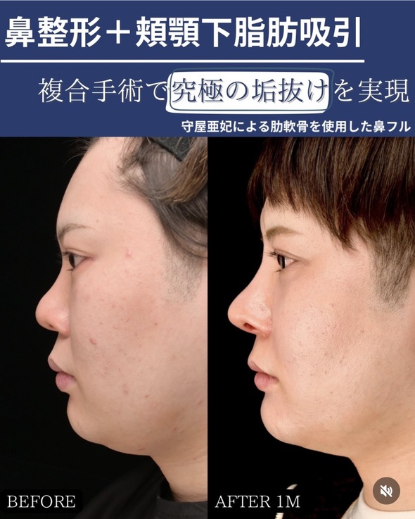 鼻整形のビフォーアフター写真