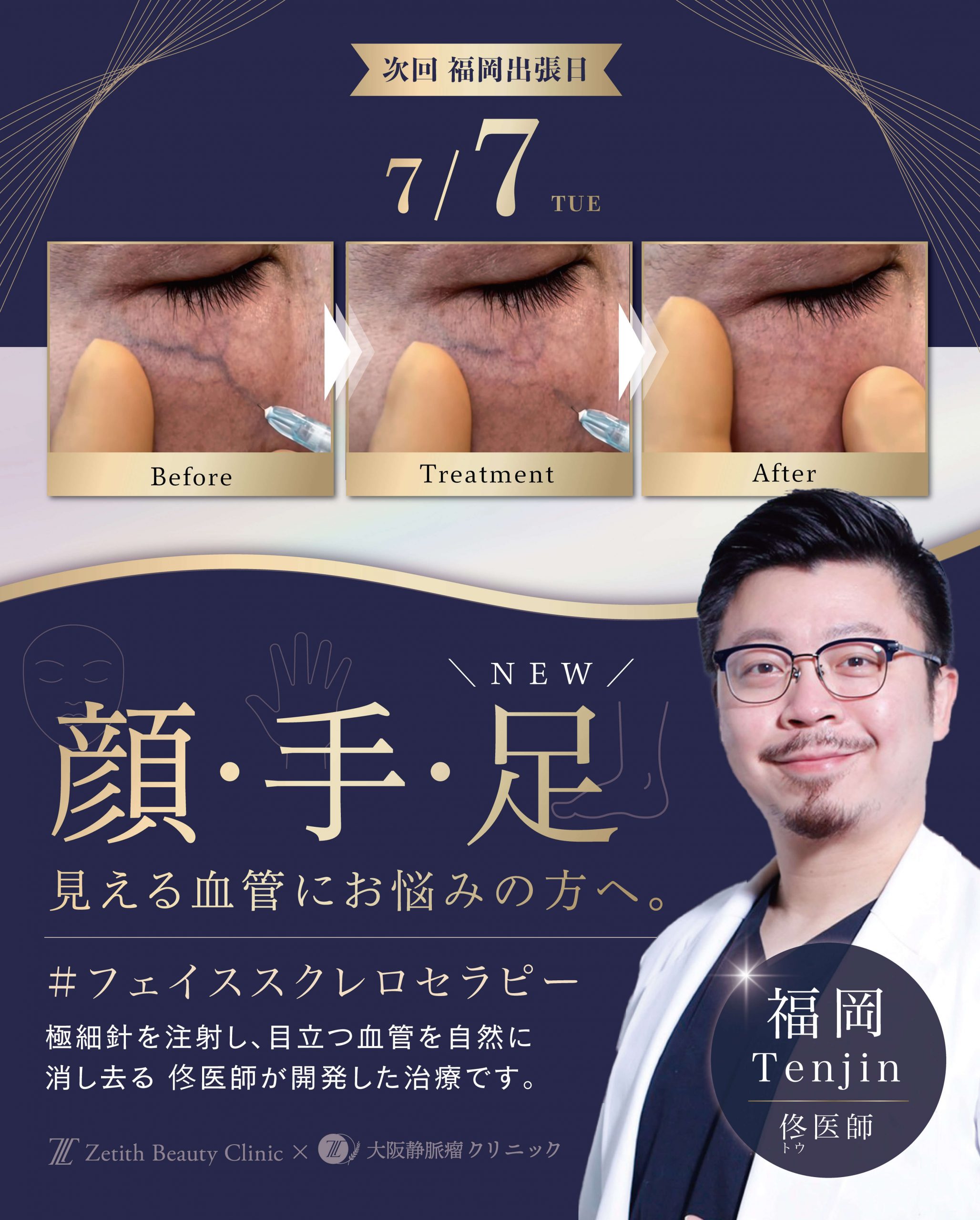 【次回の出張日7/7】 大阪静脈瘤クリニックの佟医師の施術が福岡で受けられる