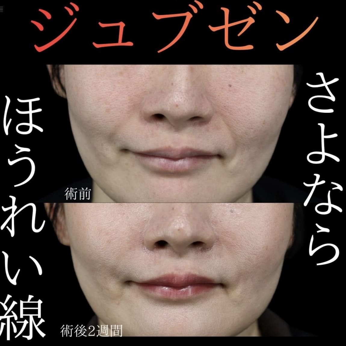 ジュブゼンのビフォーアフター写真