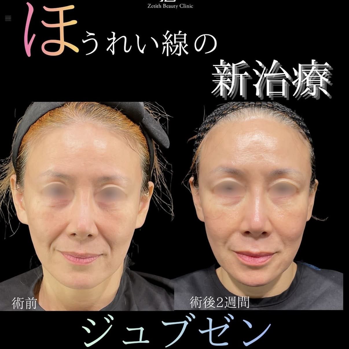 ジュブゼンのビフォーアフター写真