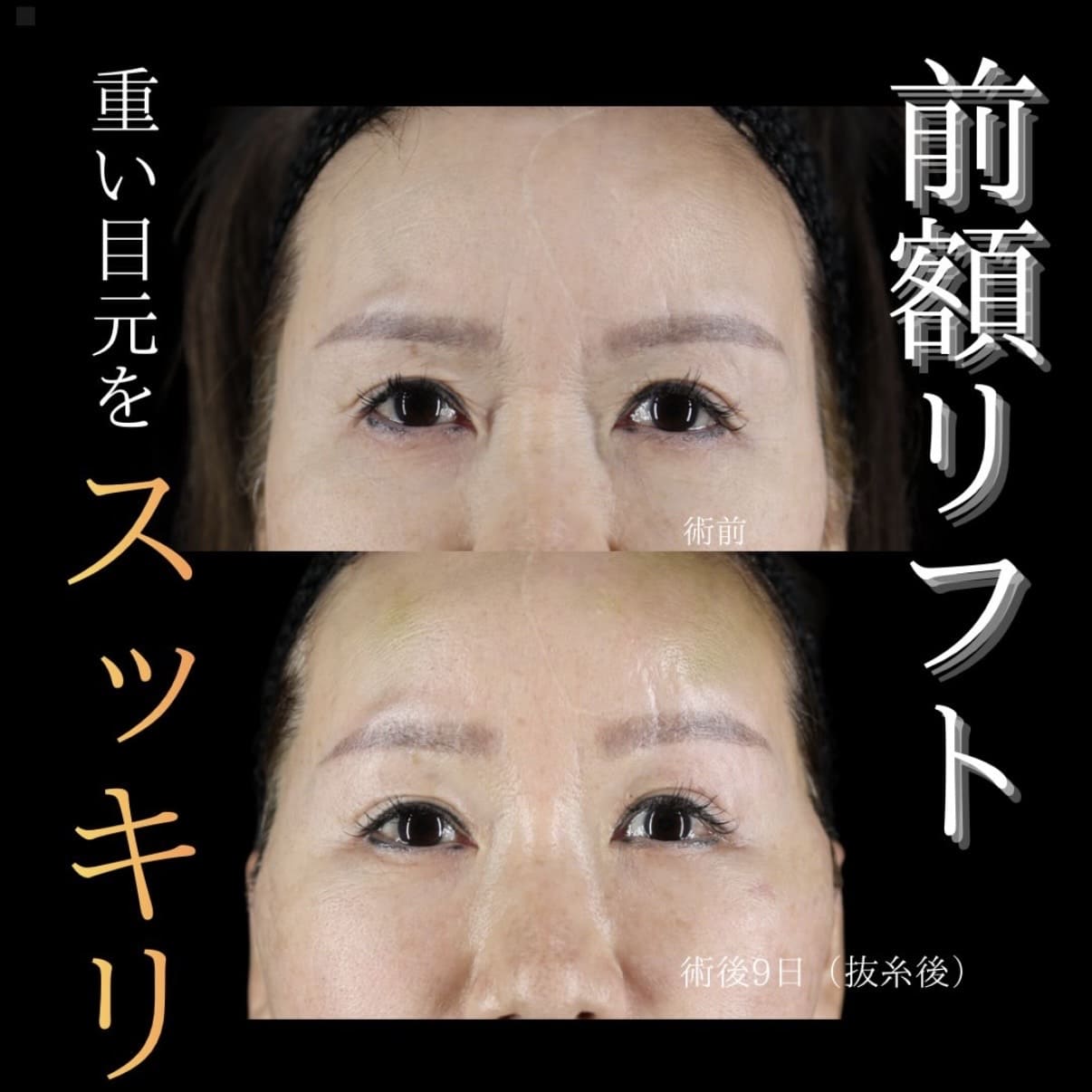 フェイスリフトのビフォーアフター写真