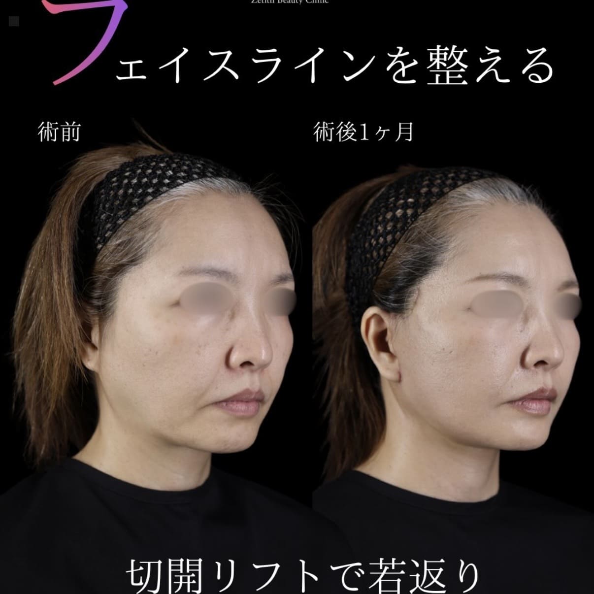 フェイスリフトのビフォーアフター写真