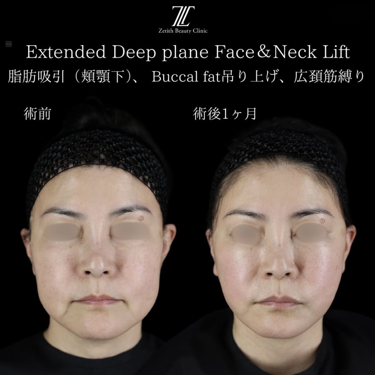 フェイスリフトのビフォーアフター写真
