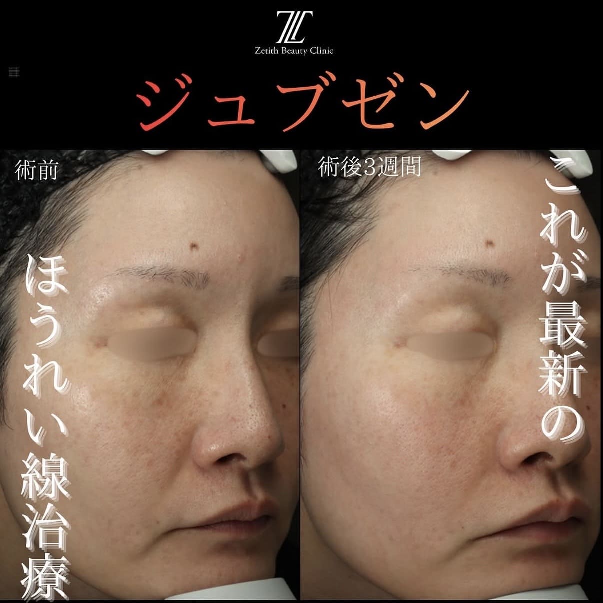 ジュブゼンのビフォーアフター写真