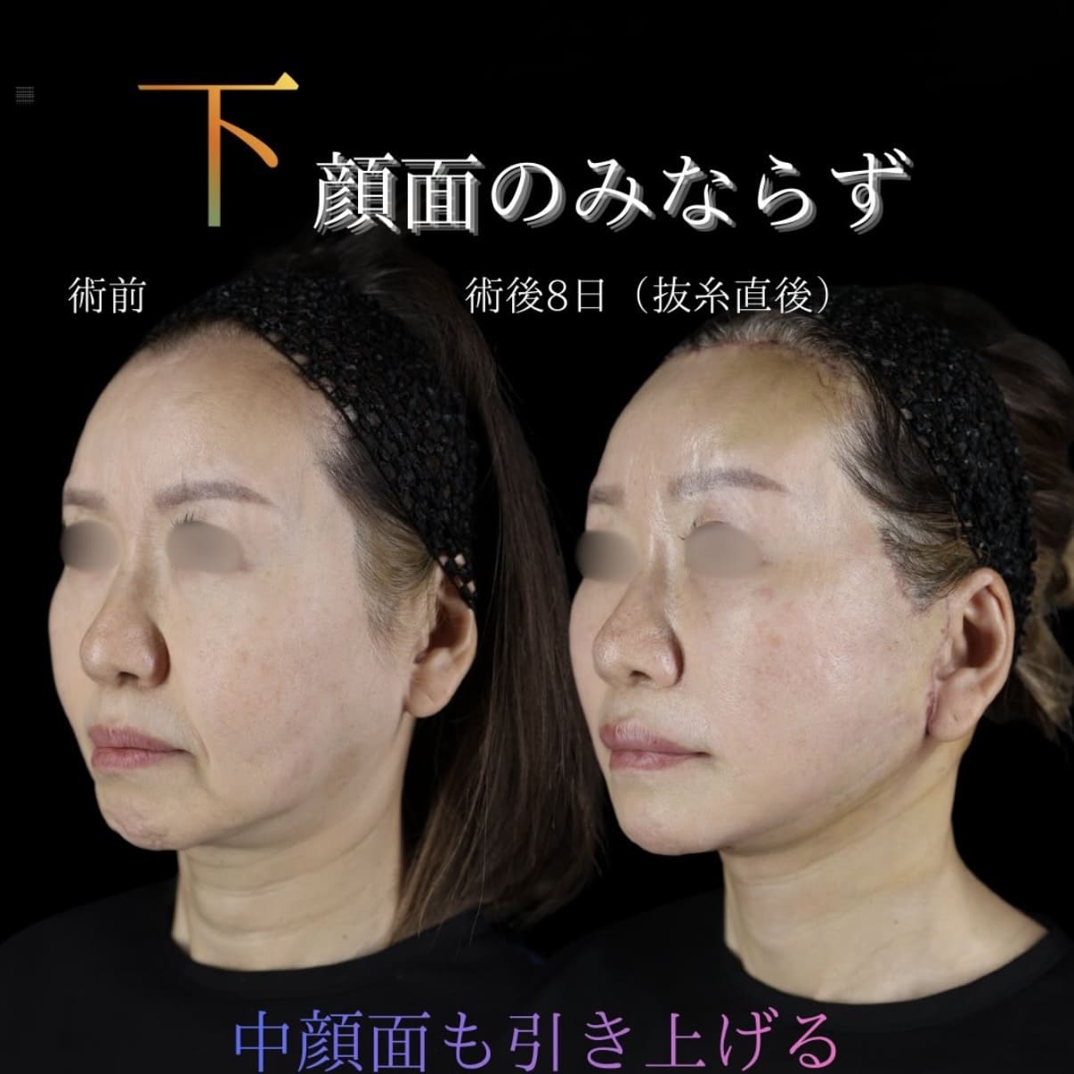 フェイスリフトのビフォーアフター写真