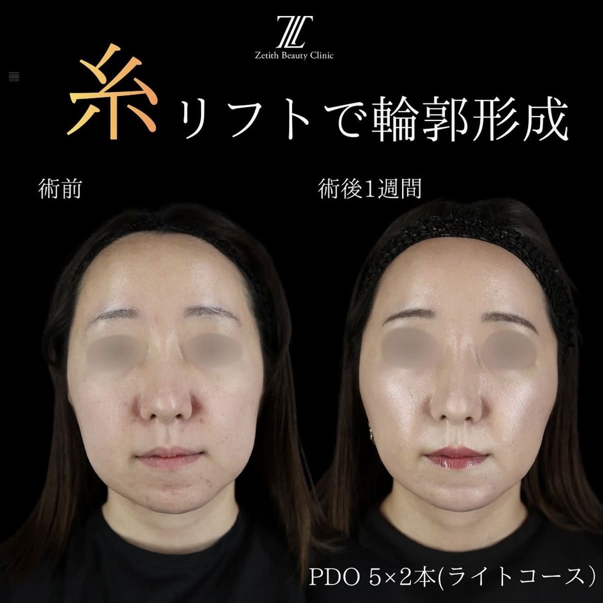 糸リフトのビフォーアフター写真
