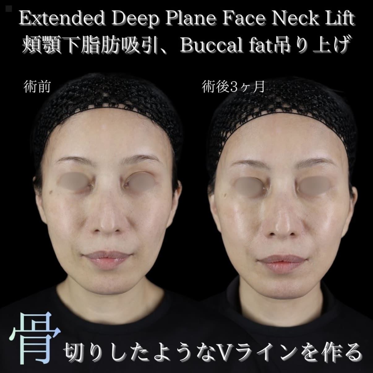 フェイスリフトのビフォーアフター写真