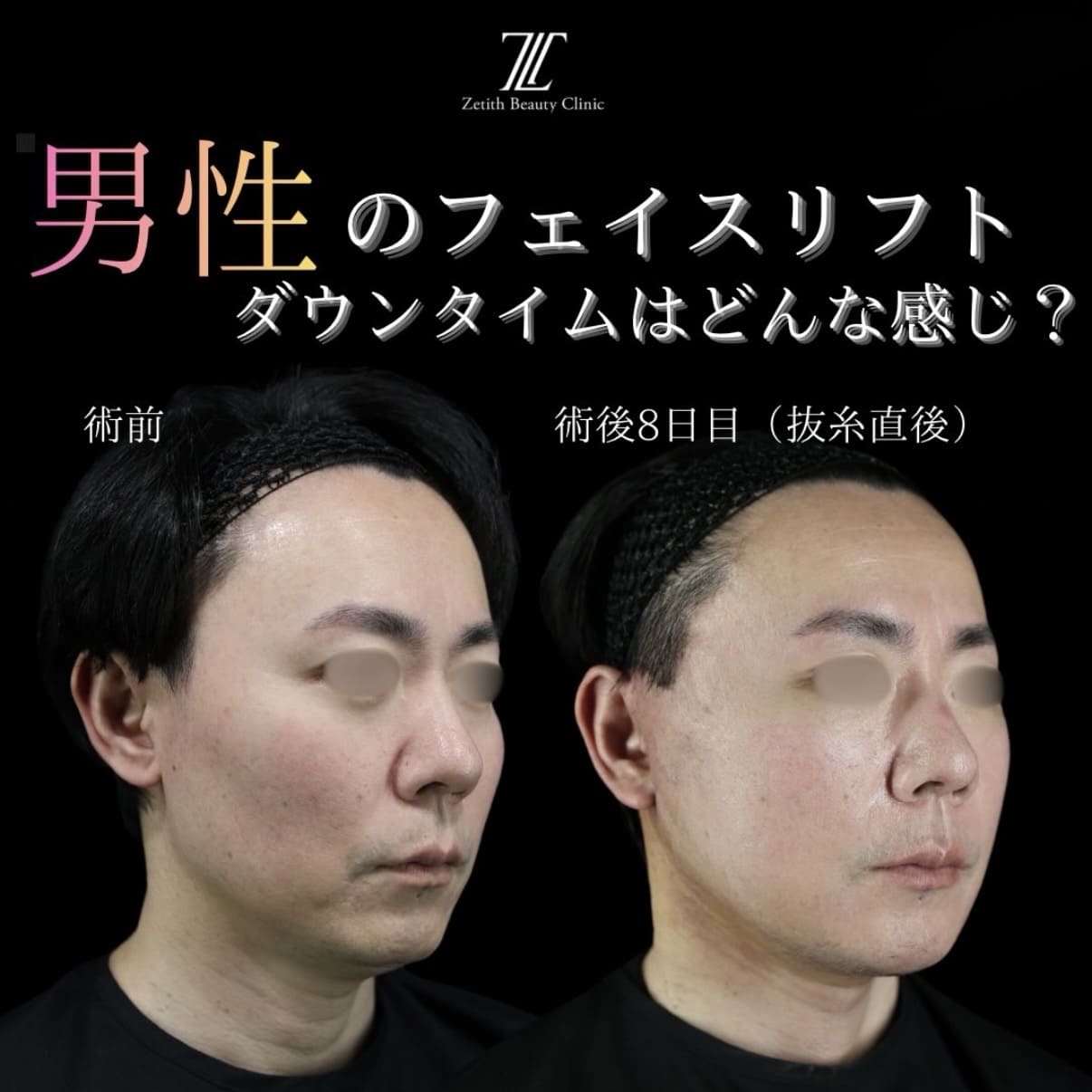 フェイスリフトのビフォーアフター写真