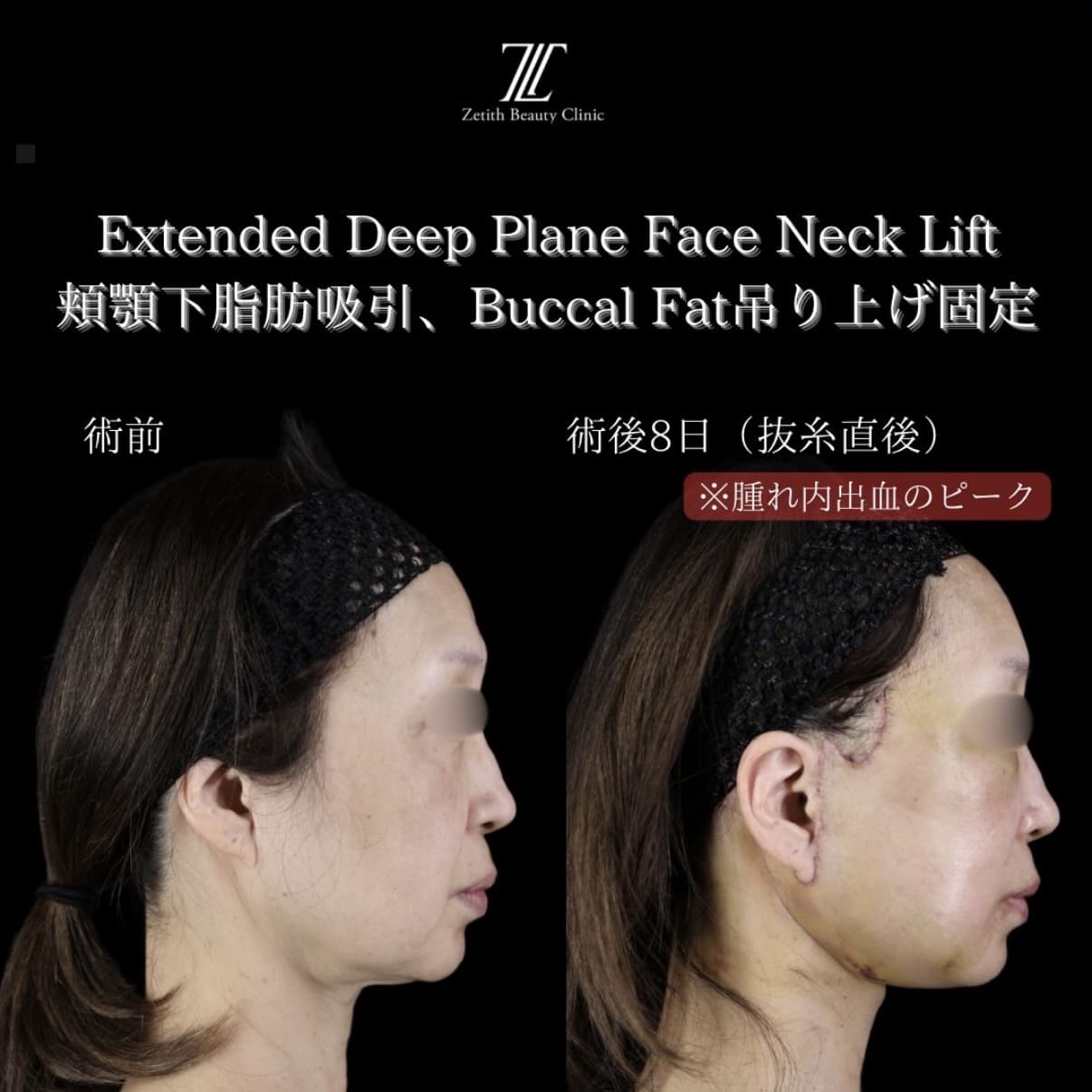 フェイスリフトのビフォーアフター写真