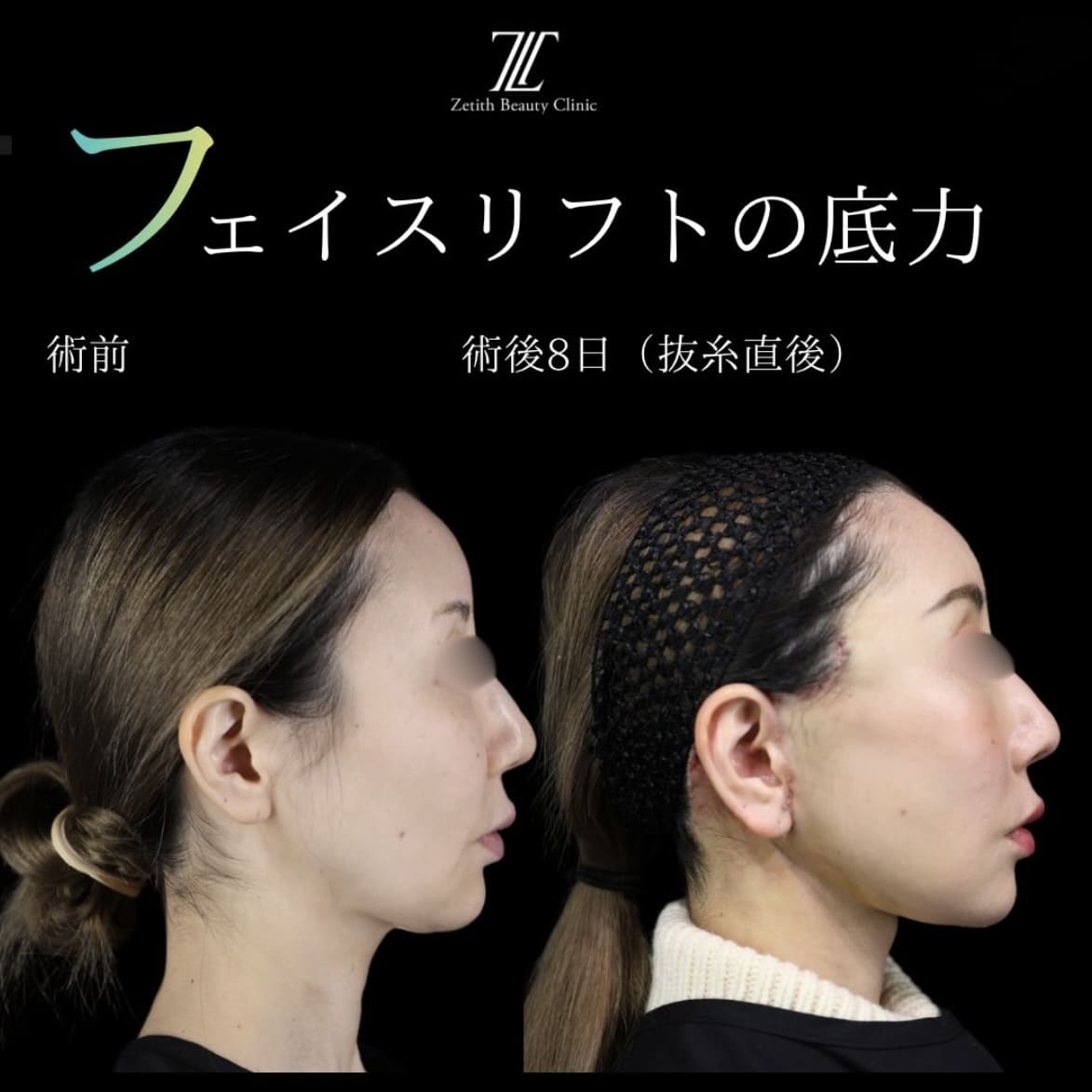 フェイスリフトのビフォーアフター写真